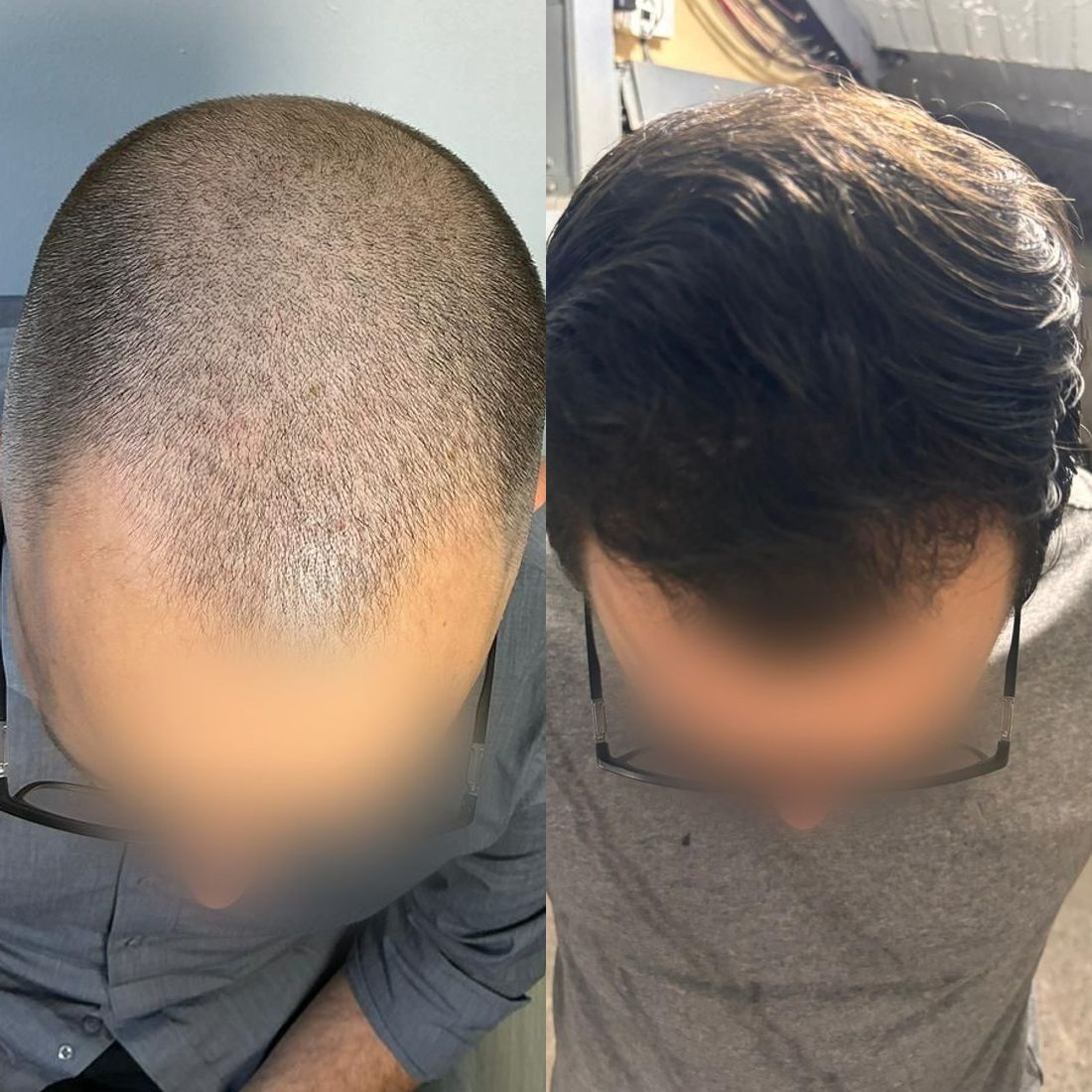 Antes y después de microinjerto capilar FUE en Haarmonia