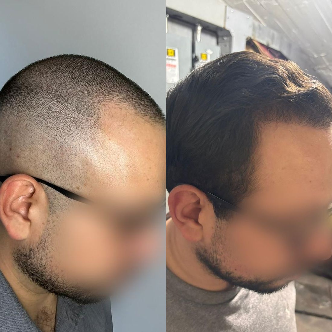Antes y después de microinjerto capilar FUE, paciente real de Haarmonia