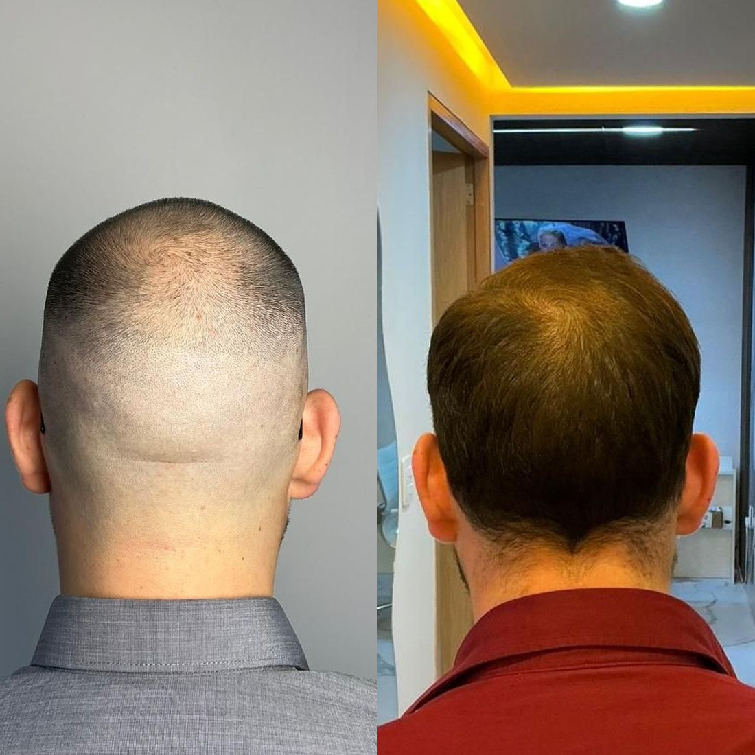 Antes y después de microinjerto capilar FUE, paciente real de Haarmonia